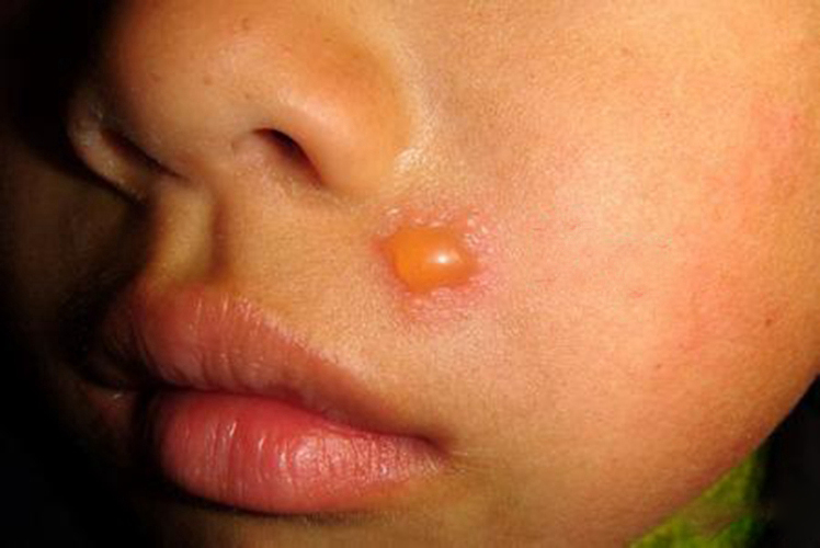 儿童嘴角单纯性疱疹水泡状图片