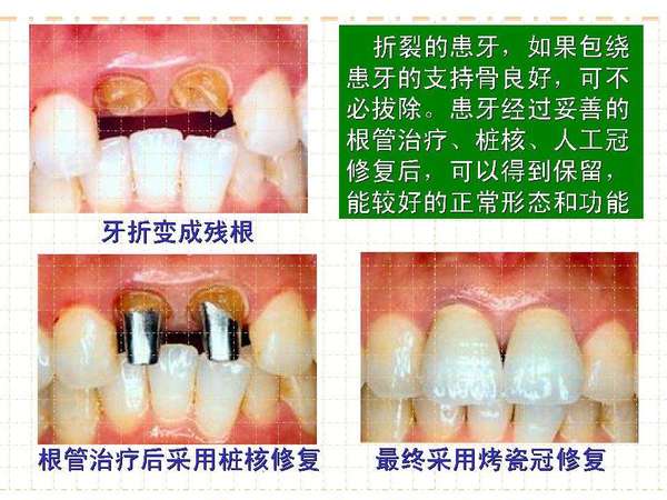 牙齿残根,残冠,折裂(牙折,纵折,隐裂)的治疗