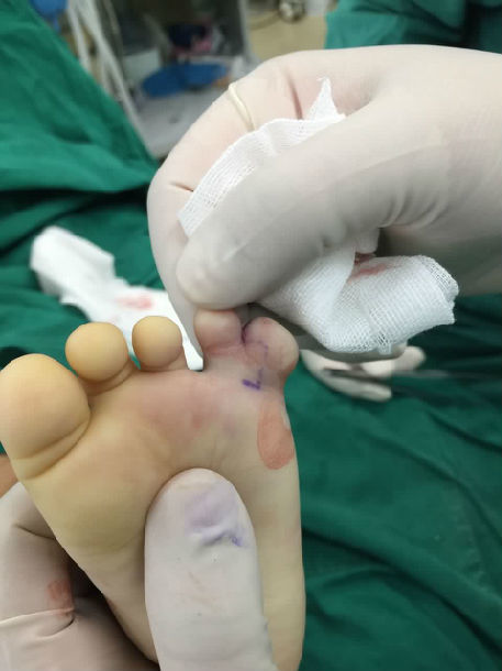 多指趾并指趾复合畸形案例
