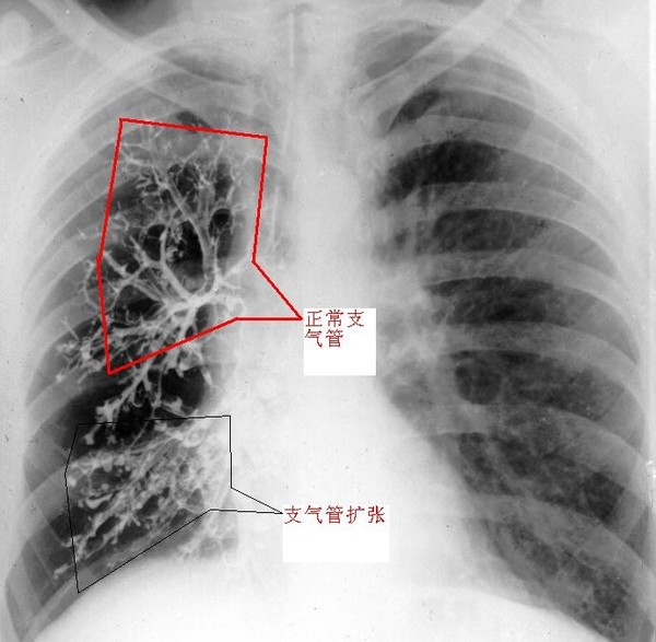 什么是支气管扩张(转载)