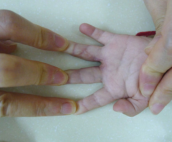经历两次手术.用这个病例说明植皮色差和指背瘢痕的比较.