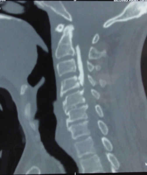 颈椎前纵韧带钙化图片