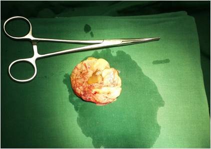 全腹腔下镜腹膜后巨大淋巴管囊肿切除术