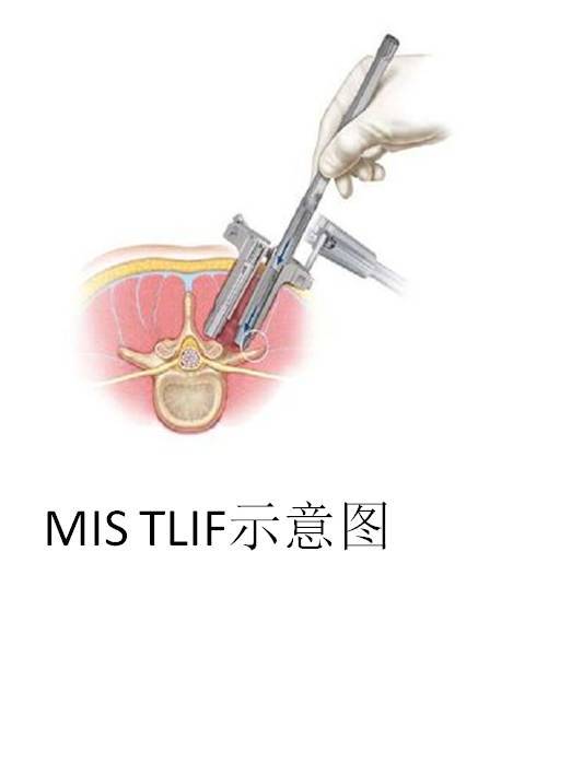 腰椎微创手术之mis tlif