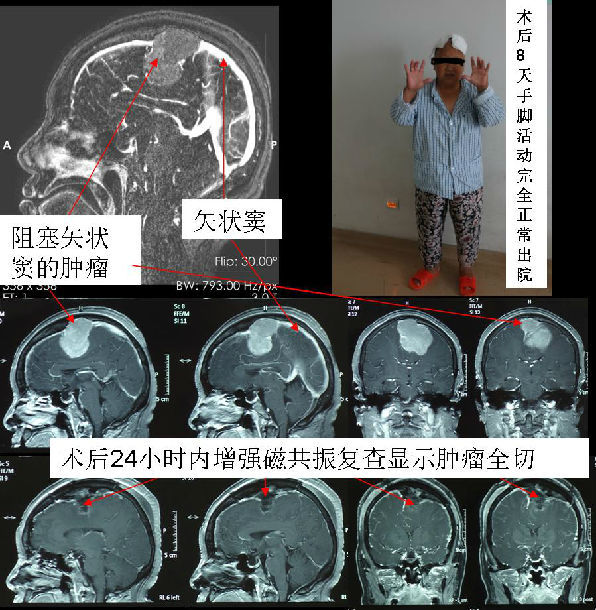 矢状窦旁脑膜瘤手术