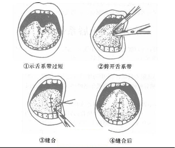 舌系带短怎么办?