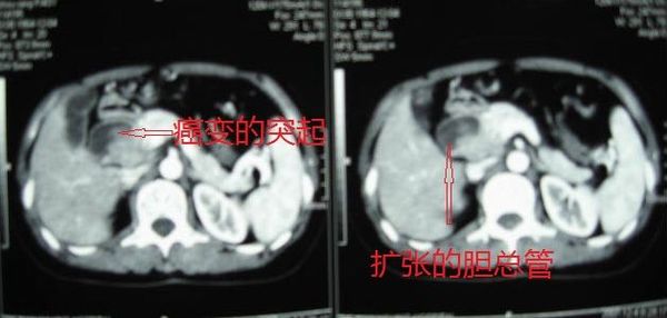 例:胆总管囊肿癌变行胰头十二指肠切除术患者的术前ct