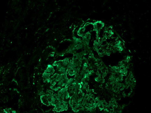 弥漫球性系膜区及毛细血管襻c3沉积(免疫荧光染色)