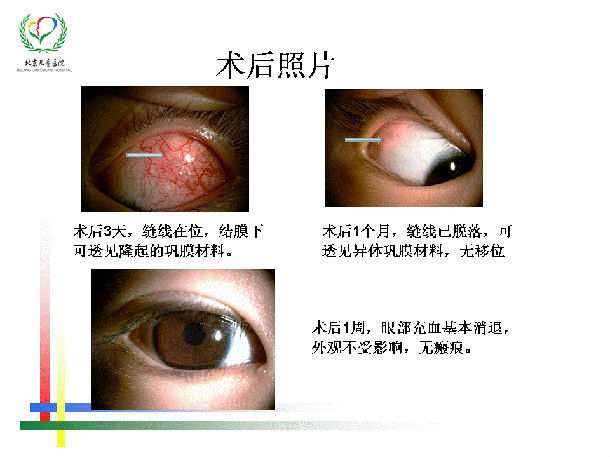 后巩膜加固术治疗青少年,儿童高度近视介绍