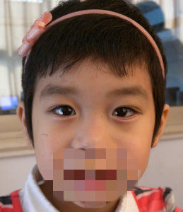 儿童特发性睑内翻倒睫如何治疗?