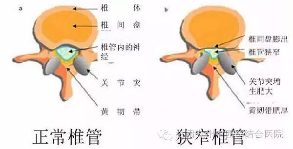 先天性椎管狭窄是由于在脊柱的生长形成中,包括营养,外伤等因素