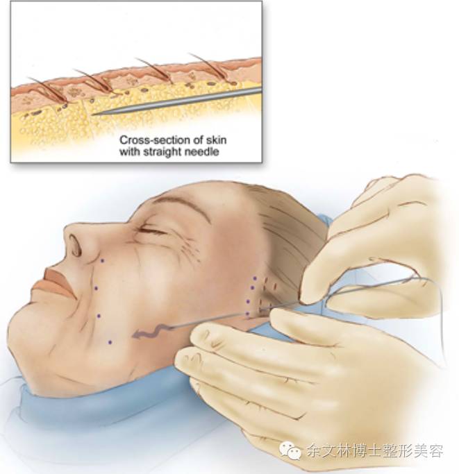 面部埋线提升之一带齿线原理_余文林