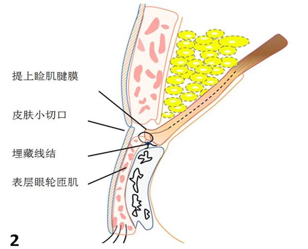 非常大的是如何把虚线圈定范围内的睑板前组织较为彻底的分层清除干净