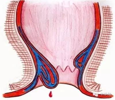 严重者不仅在解便时痔团脱出,甚至咳嗽,劳顿,行走时亦会脱出肛门