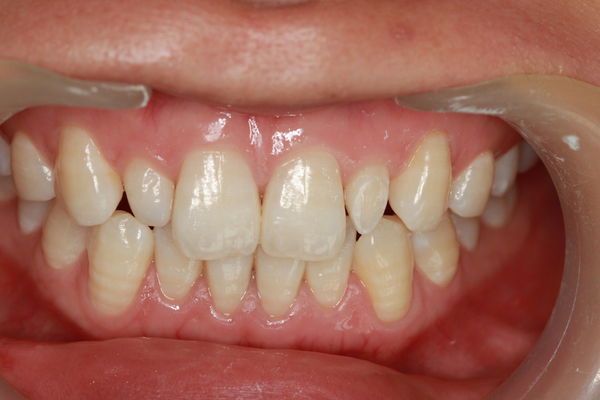 1,双侧上侧切牙畸形过小牙.