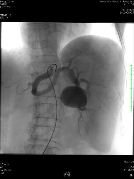 介入栓塞联合微波消融治疗复杂脾动脉瘤并重度脾亢及肝癌