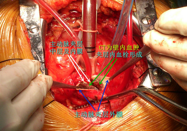 主动脉夹层ct显示和术中图片比较!