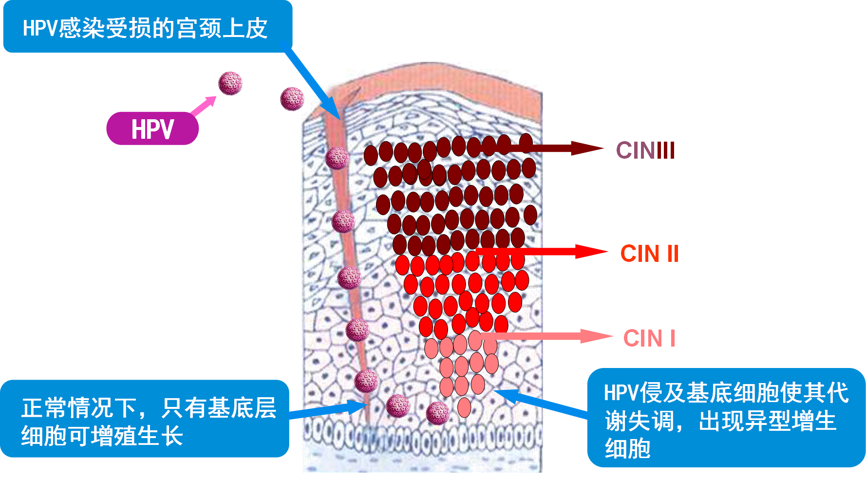 HPV感染就一定会发展成宫颈癌吗?