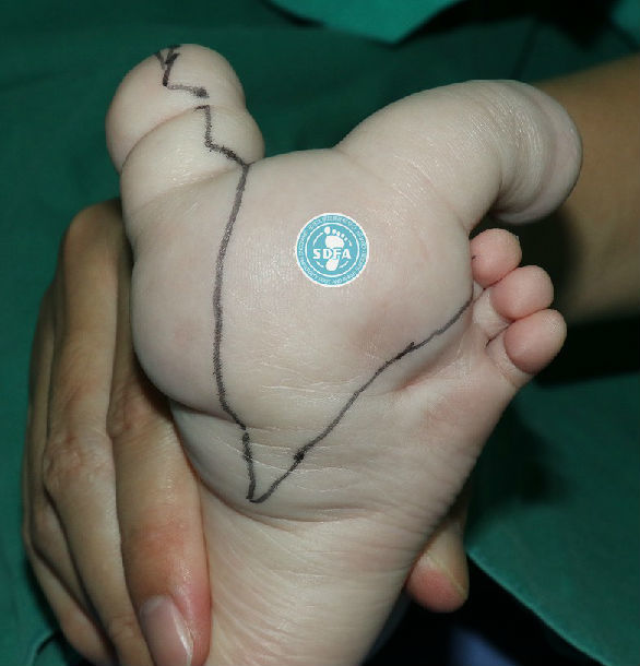 第2趾巨趾,如切除第2趾可引起拇趾外翻畸形,应慎重.
