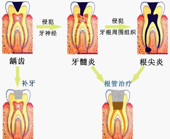 乳牙牙髓炎的特点和危害
