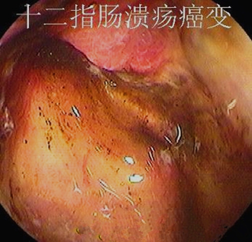 十二指腸潰瘍a1期癌變圖片