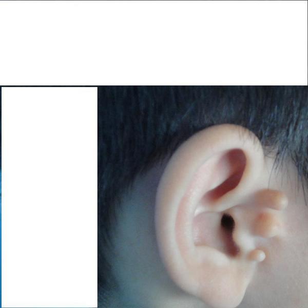 对于一般的副耳做个简单的小手术切除就能达到美容目的,对于复杂的