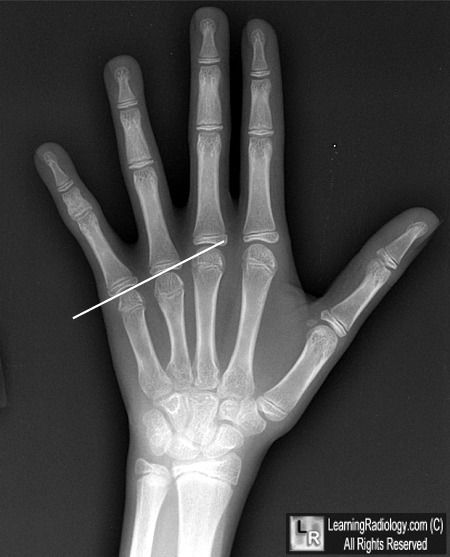 Turner综合征(先天性卵巢发育不全综合征)