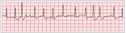 心房颤动简称房颤,是临床最常见的心律失常之一.