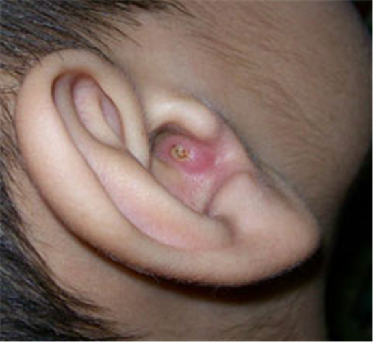 儿童外耳道炎症状图片