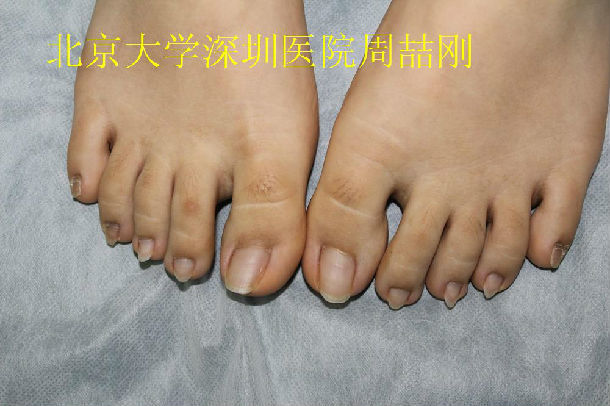 嵌甲甲沟炎――甲床成形术的手术过程及术后随