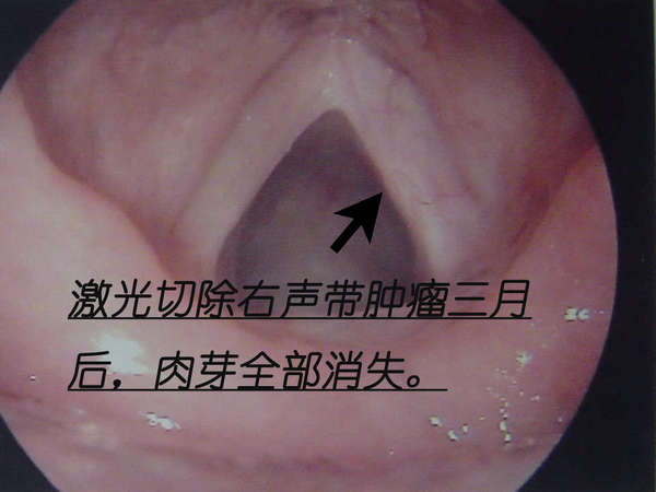 声带癌_声带癌症状