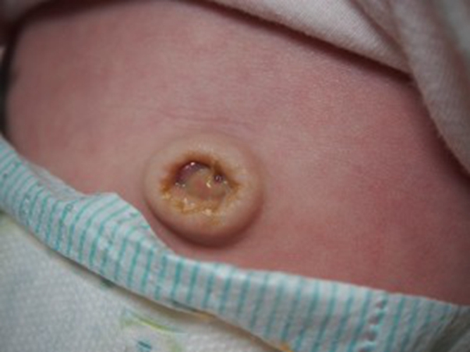 婴儿的脐炎 图片