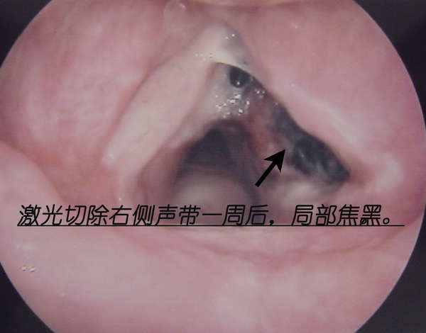 早期喉癌(声带癌)的激光手术治疗