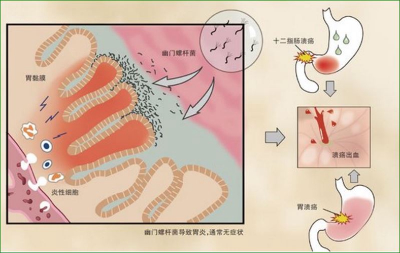 慢性十二指腸潰瘍癥狀的圖片