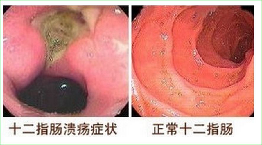 十二指肠溃疡