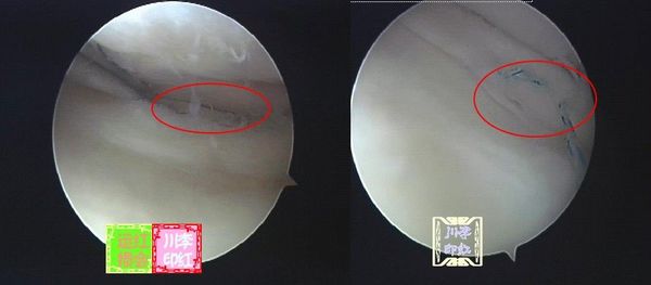 半月板损伤的治疗方法