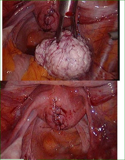 子宫粘膜巧克力囊肿图片