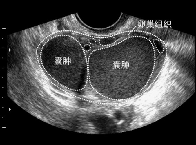 巧克力囊腫b超圖片