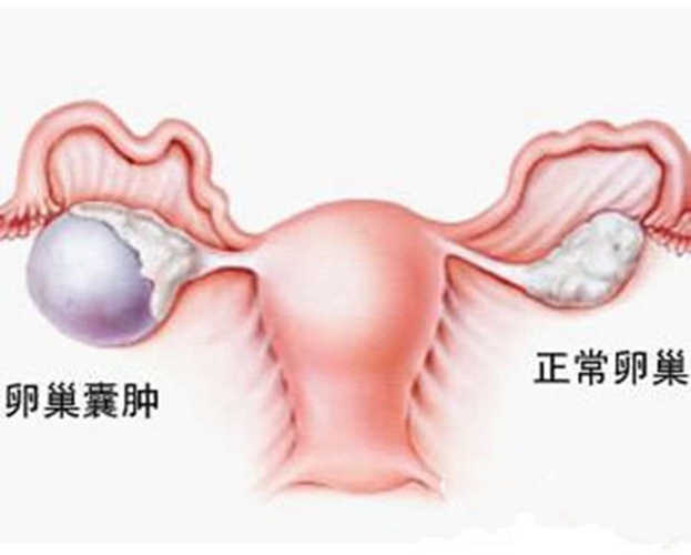 右卵巢巧克力囊肿的图片