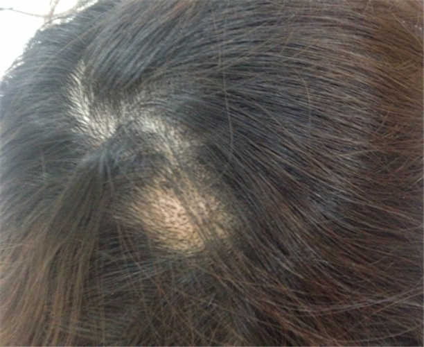 女性头部头皮毛囊炎图片