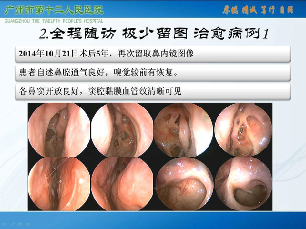 难治性鼻-鼻窦炎可治愈性临床观察