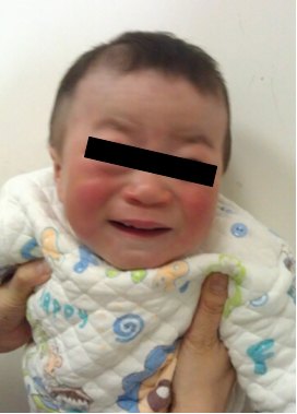 医学科普:黏多糖贮积症都有哪些临床表现_刘舒