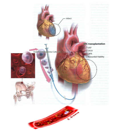 闭塞冠状动脉开通支架置入,经导管将干细胞移植至坏死心肌.如图