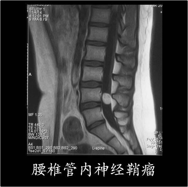 椎管神经鞘瘤是什么?