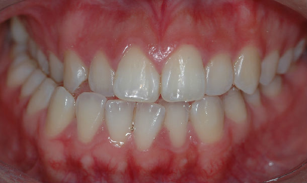 种植钉辅助上颌快速扩弓--减少拔牙矫正新技术