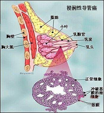 请关爱乳房,远离女性健康"头号杀手"