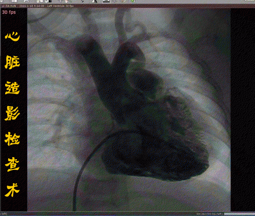 心导管检查术or心脏造影术――宝爸宝妈傻傻分不清