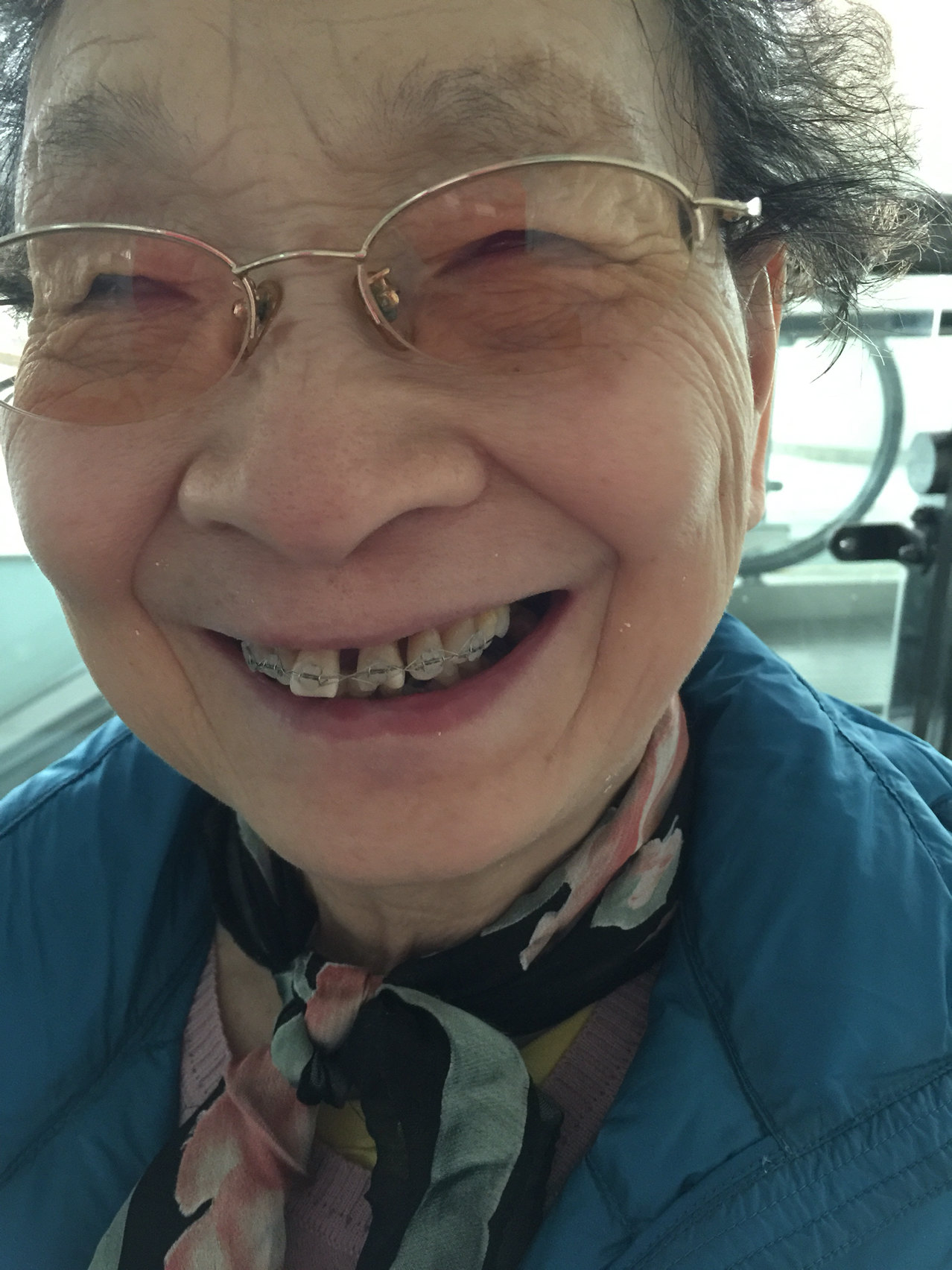 八十一岁还可以戴牙套吗?