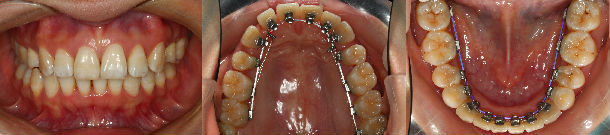 排牙试验,可以看到矫治之后的效果,并按此效果进行牙套的个性化加工