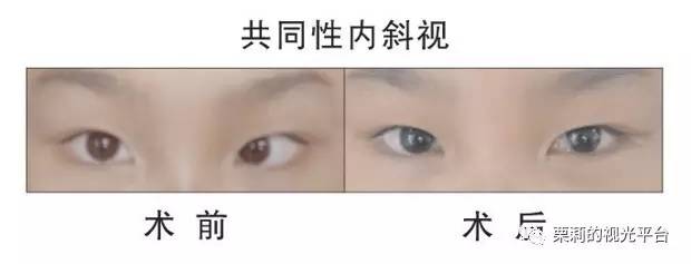 左图为斜视术前,左眼角膜映光点位于瞳孔外侧,该眼为内斜视.